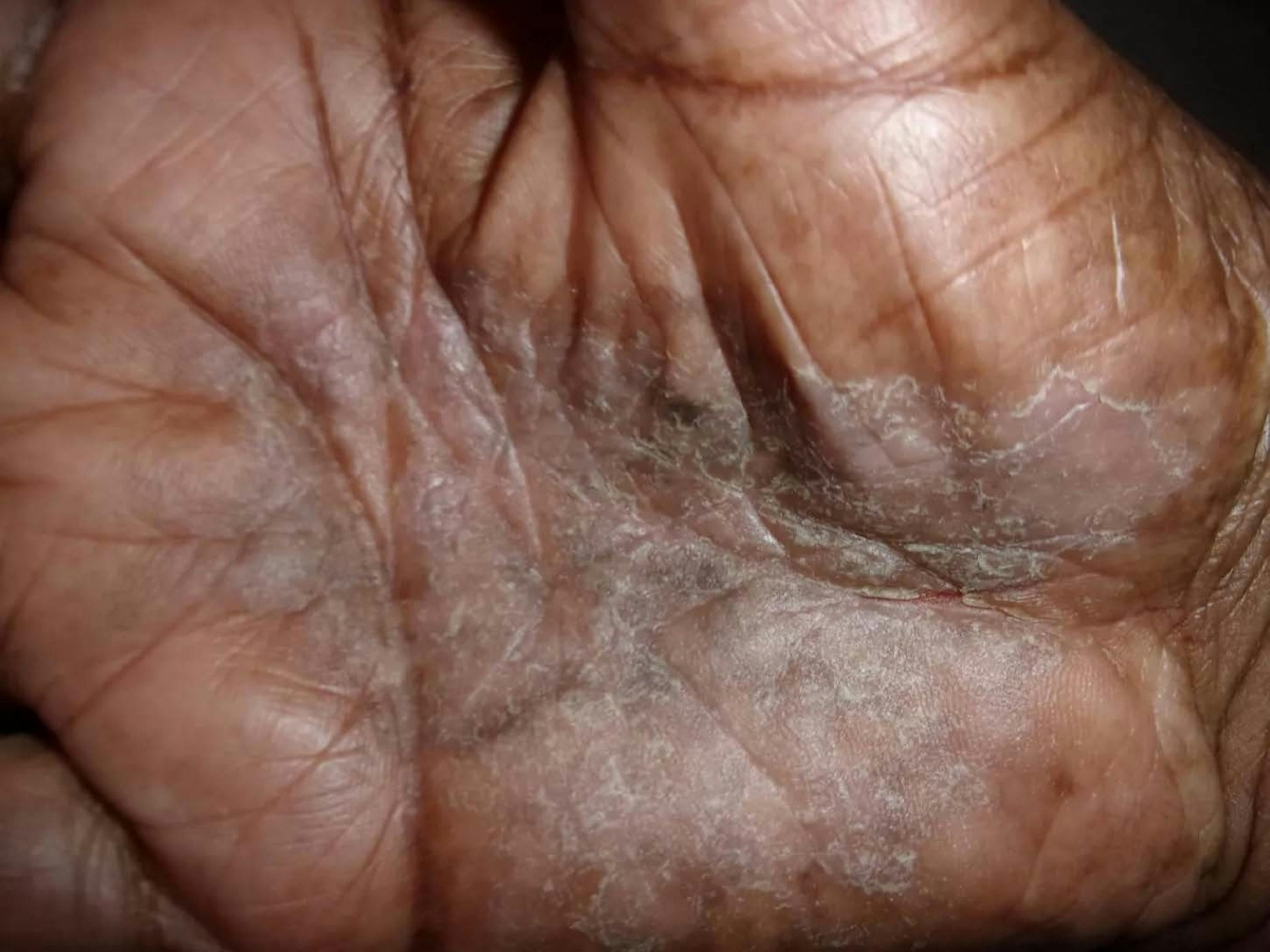 Hilton N. Webb Jr., Rough and Scarred